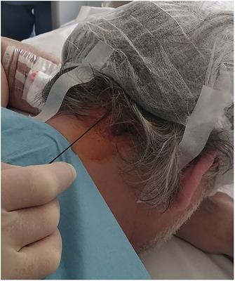 A Case Report of Pulsed Radiofrequency Plus Suboccipital Injection of the Greater Occipital Nerve: An Easier Target for Treatment of Cluster Headache